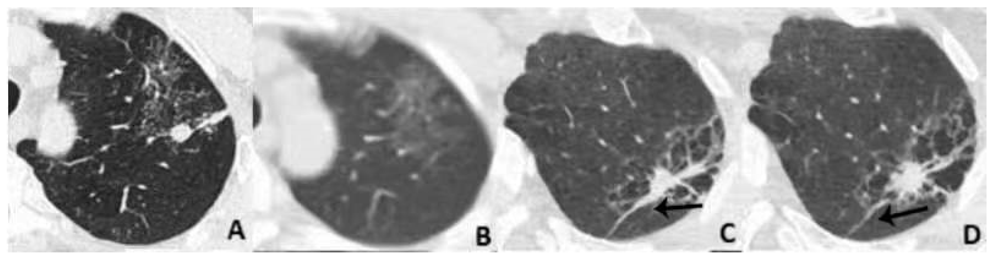 Diagnostics Free Full Text Proposal Of Modified Lung Rads In Assessing Pulmonary Nodules Of 