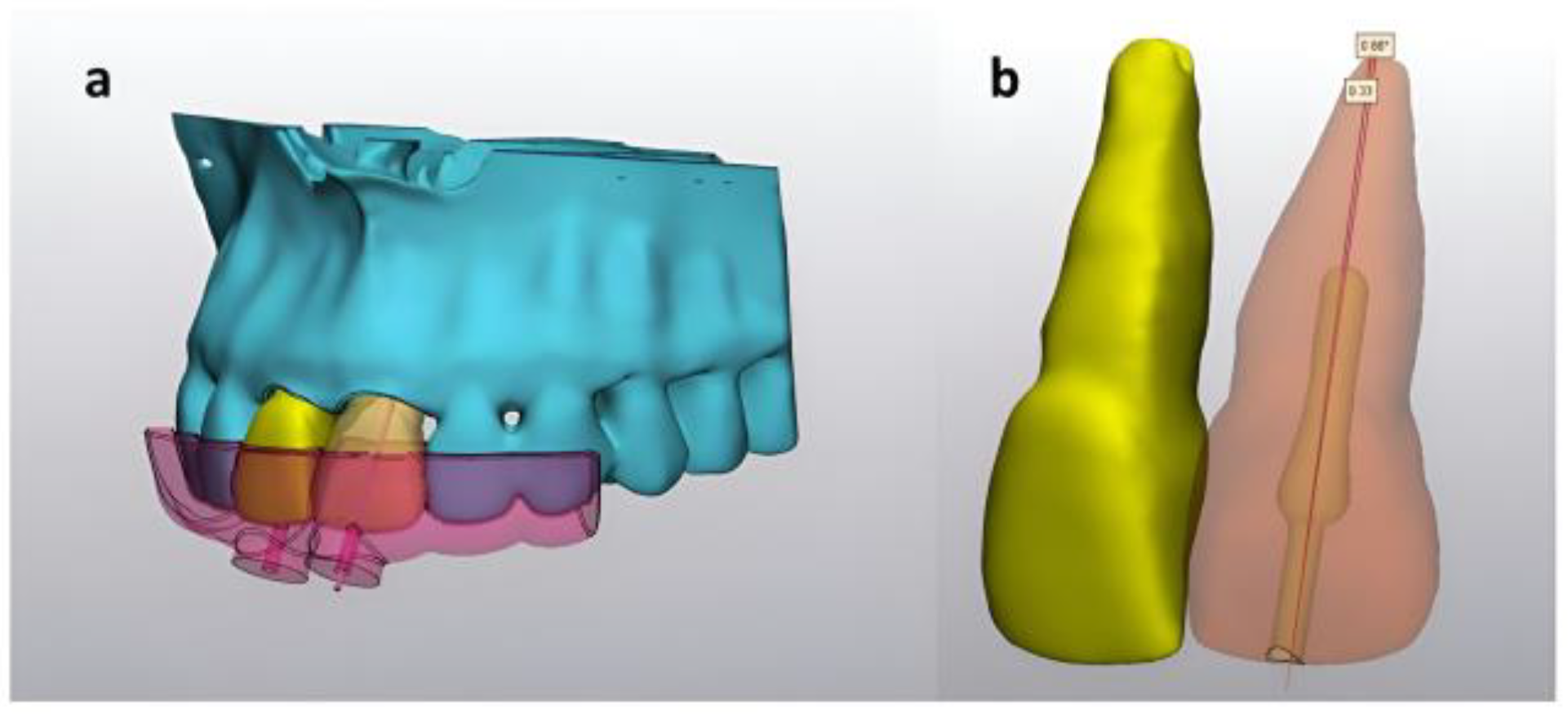The 3D model of the root canal system of the sample presented in Fig.