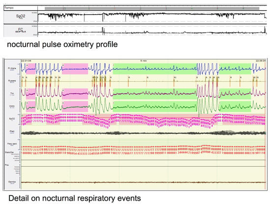 The Link Between Sleep Apnea and Sports Performance - Speedy