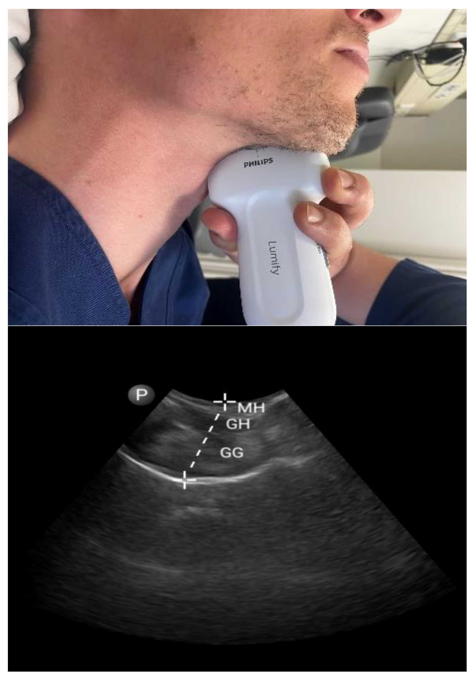 Cureus, Obstructive Sleep Apnea and Role of the Diaphragm