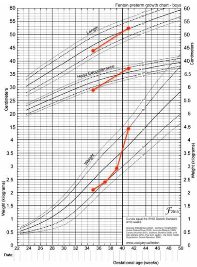 Continuous Glucose Monitoring in Transient Neonatal Diabetes Mellitus—2 ...