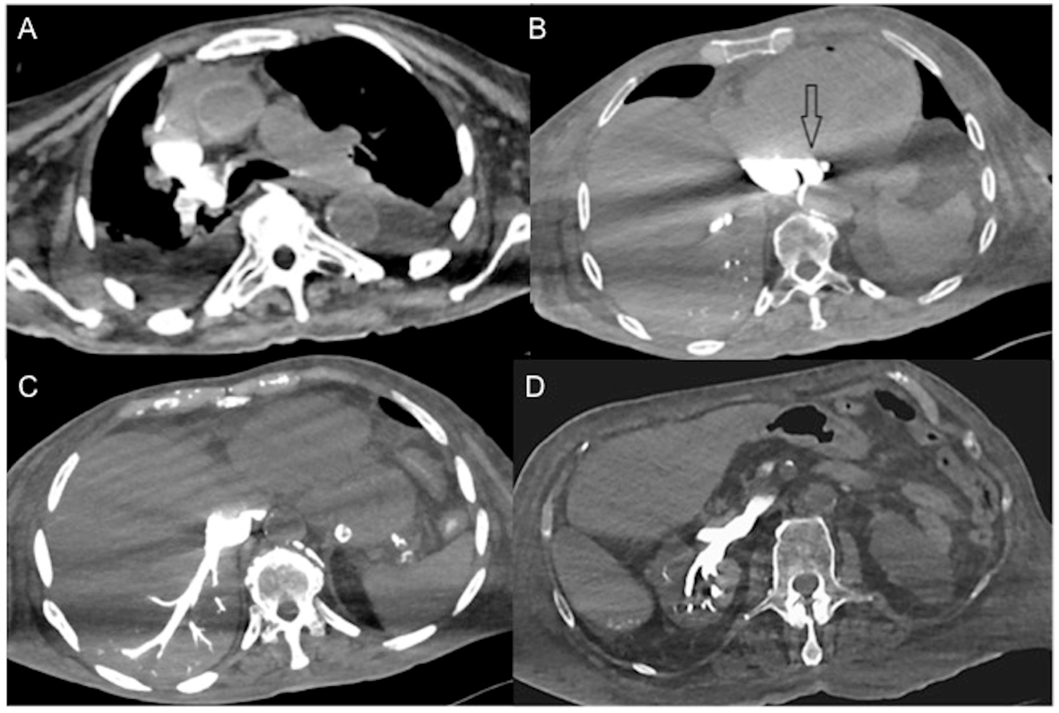 Diagnostics | Free Full-Text | Multidetector CT Imaging Biomarkers