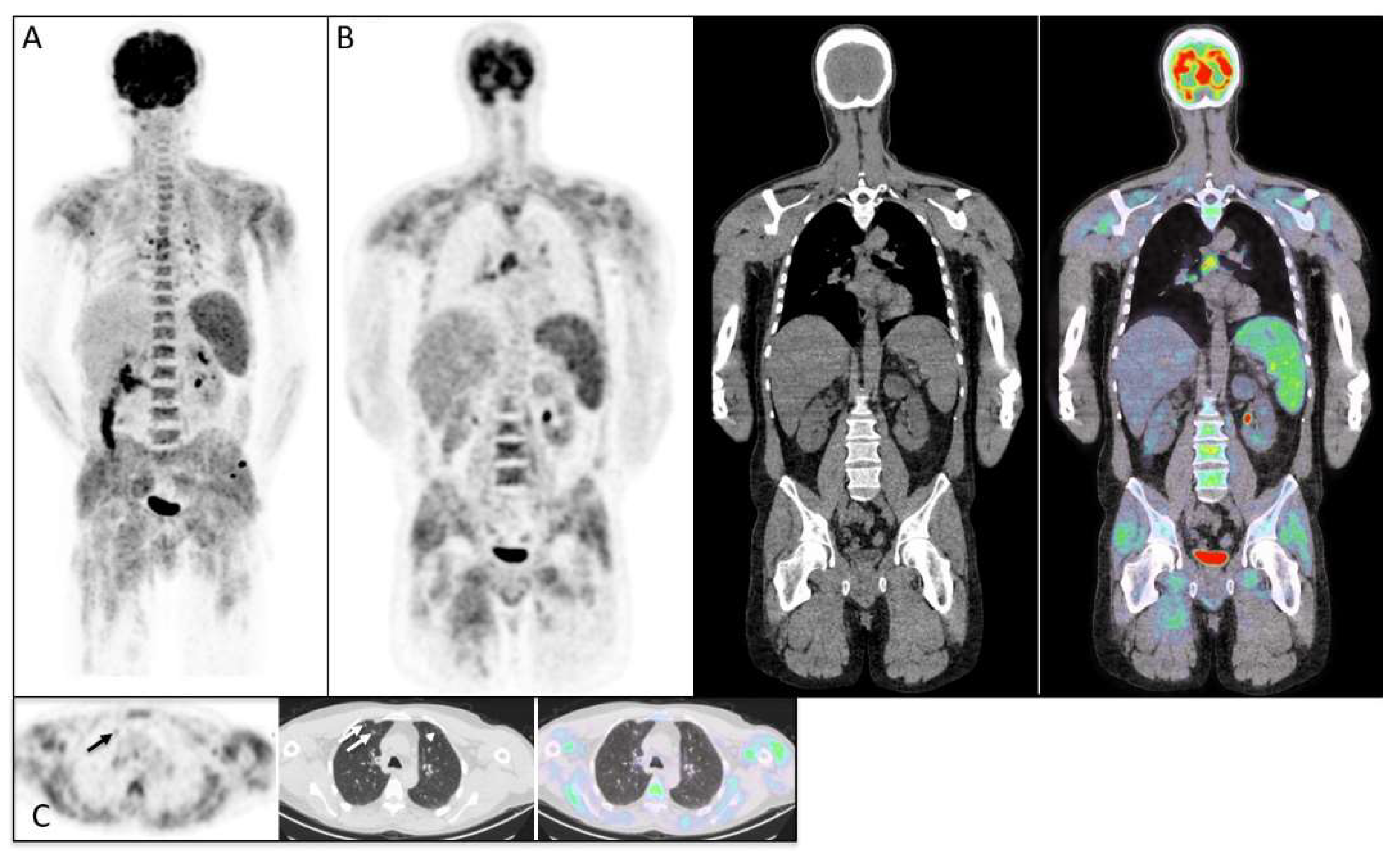 Diagnostics | Free Full-Text | [18F]FDG-PET/CT In Idiopathic ...