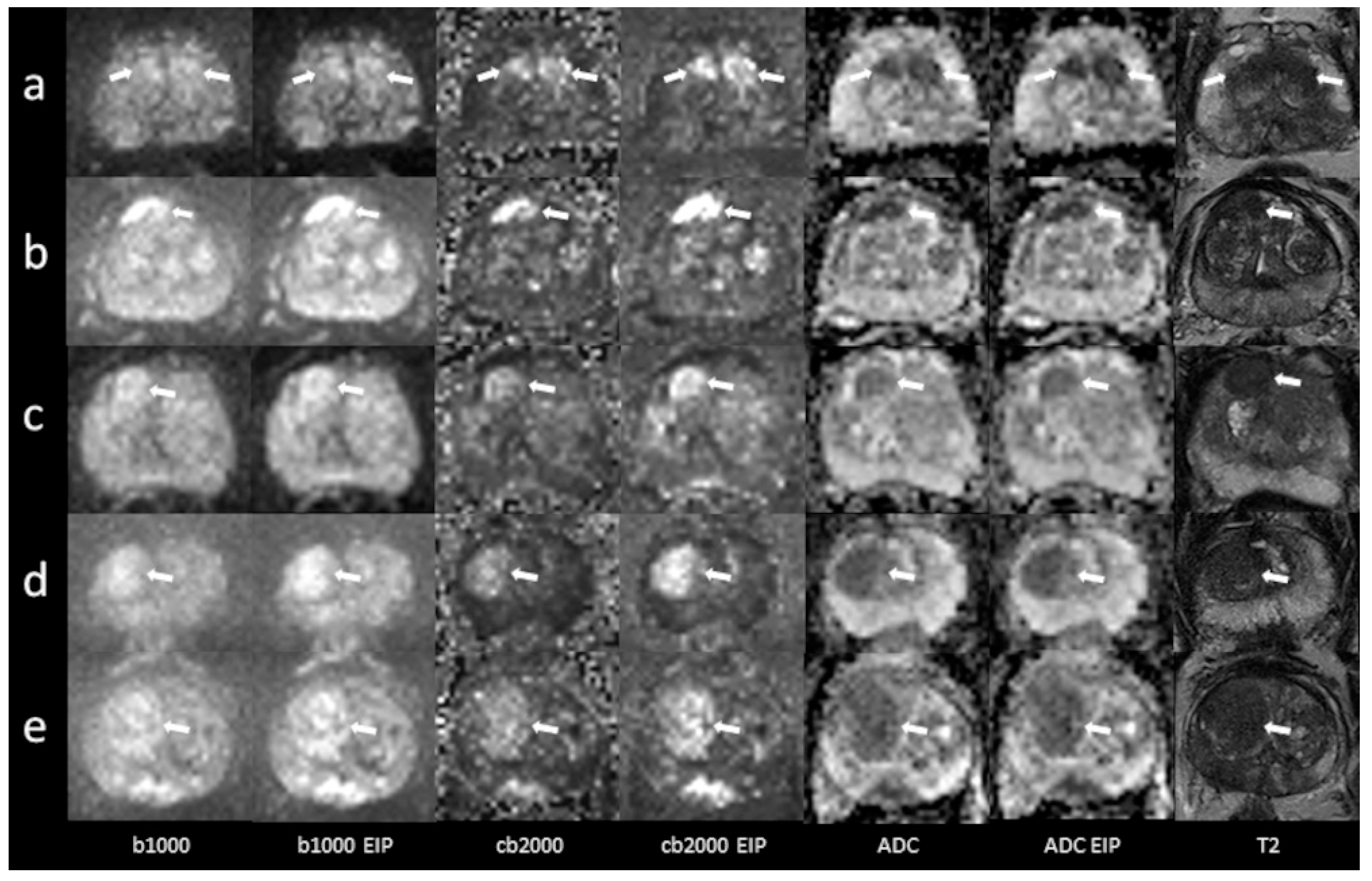 Frontiers  Multiparametric magnetic resonance imaging-derived