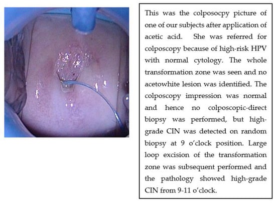 Diagnostics Free Full Text The Value Of Four Quadrant Cervical Biopsy In Women With 