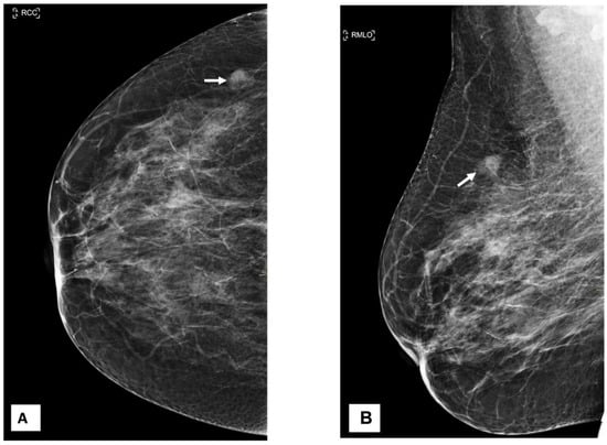 Small mass in breast mammogram, Radiology Case