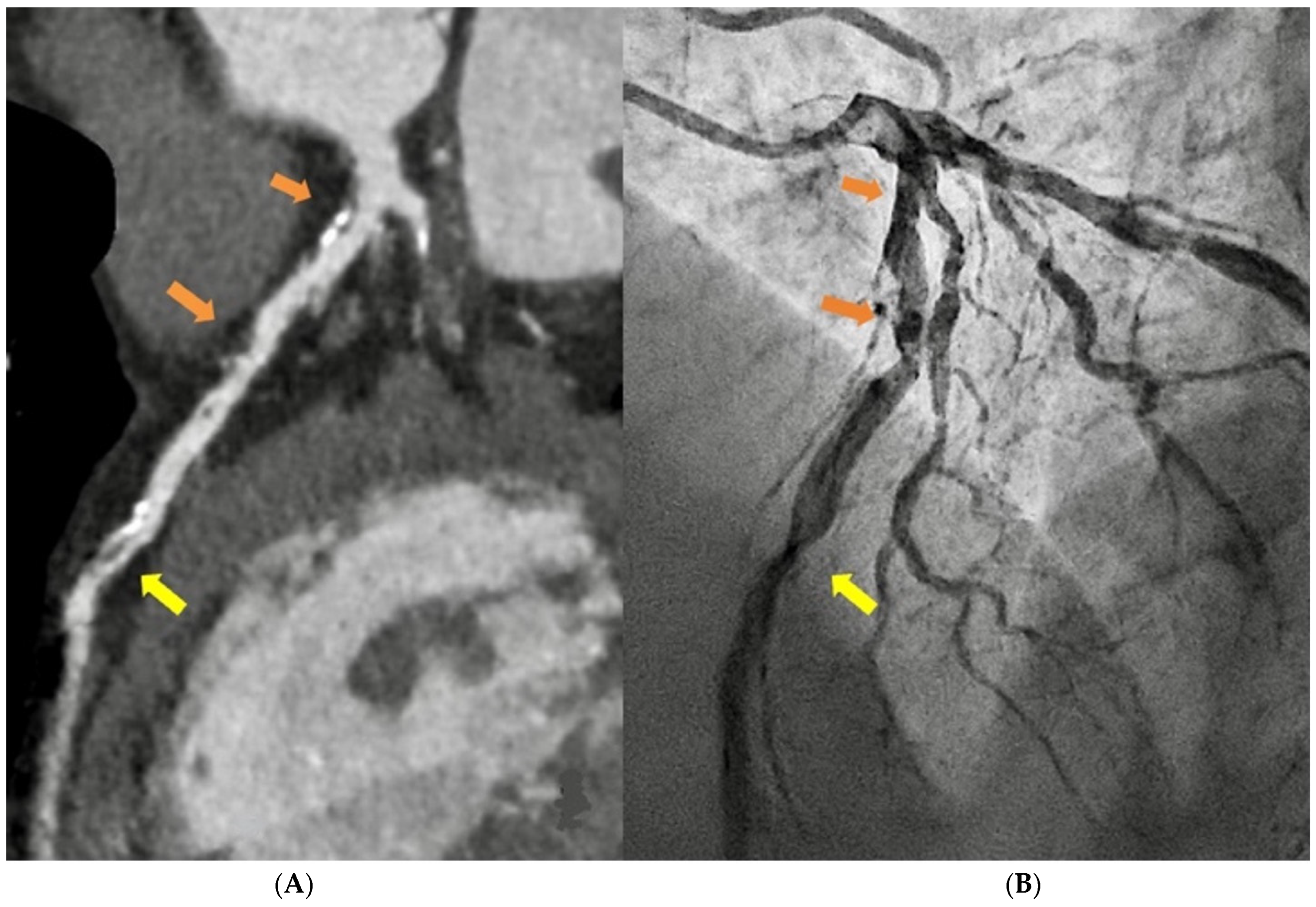 Reproducibility of 4D cardiac computed tomography feature tracking