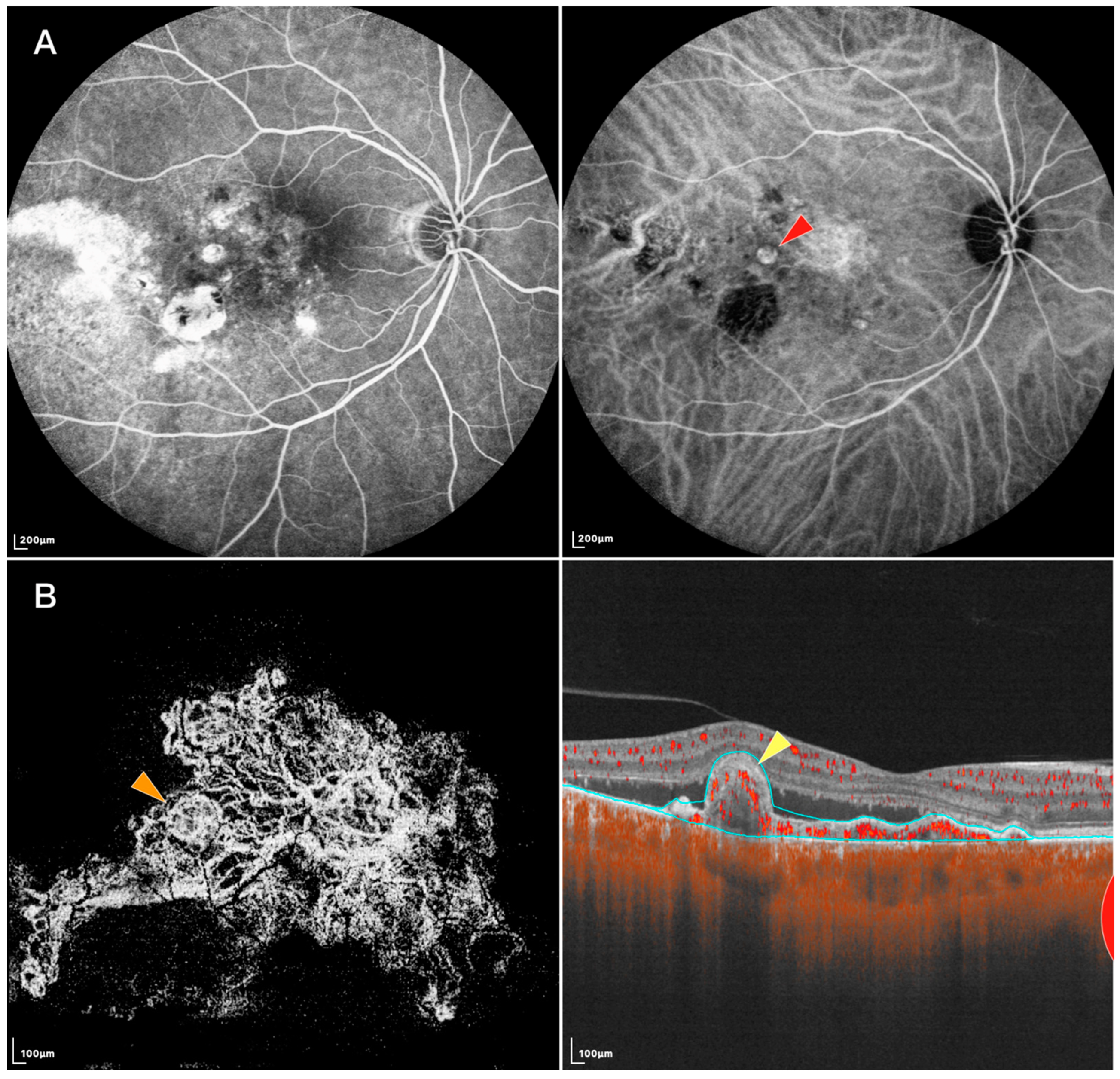 Diagnostics | Free Full-Text | Recent Advances in Imaging Polypoidal  Choroidal Vasculopathy with Swept-Source Optical Coherence Tomography  Angiography