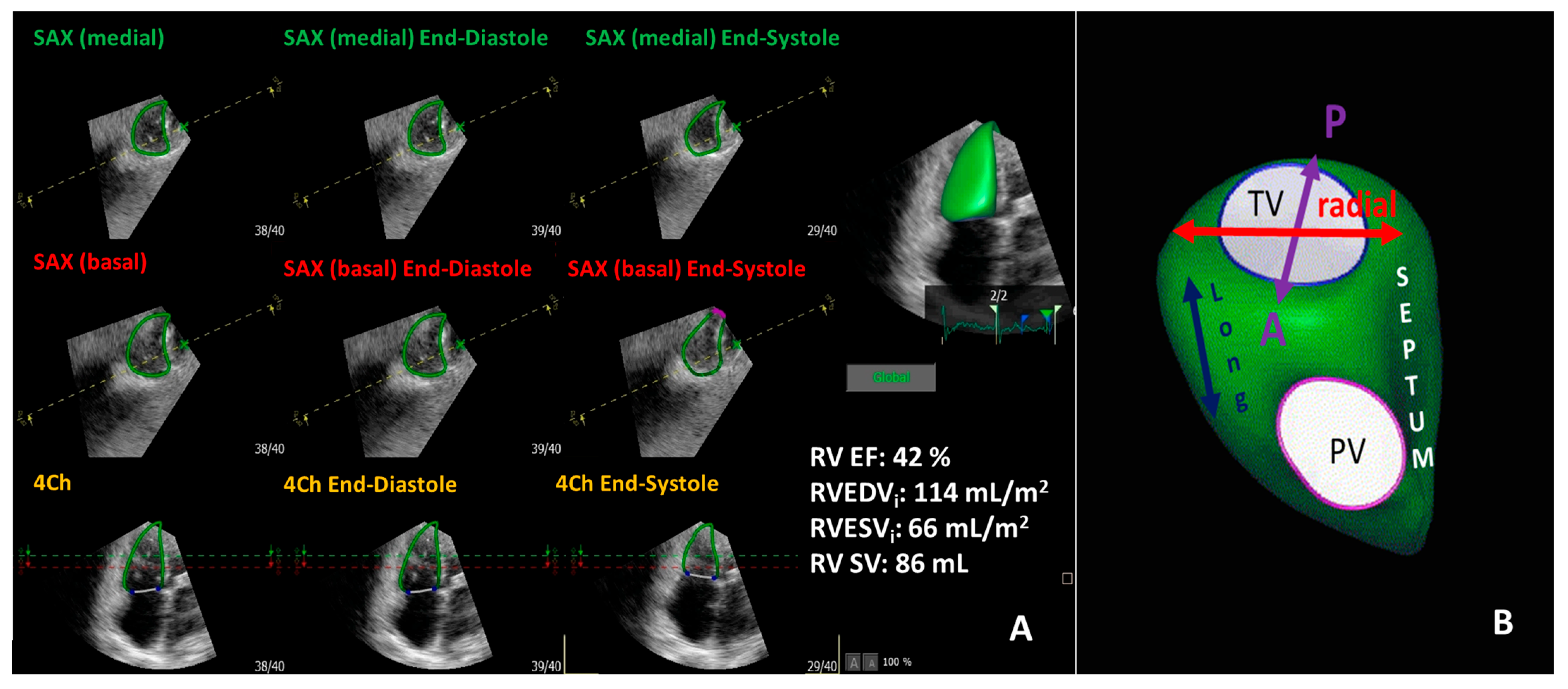 RV Global Longitudinal Strain a Predictor of Mortality in Ebstein