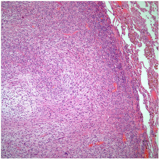 Diagnostics | Free Full-Text | Primary Pulmonary Carcinomas with ...