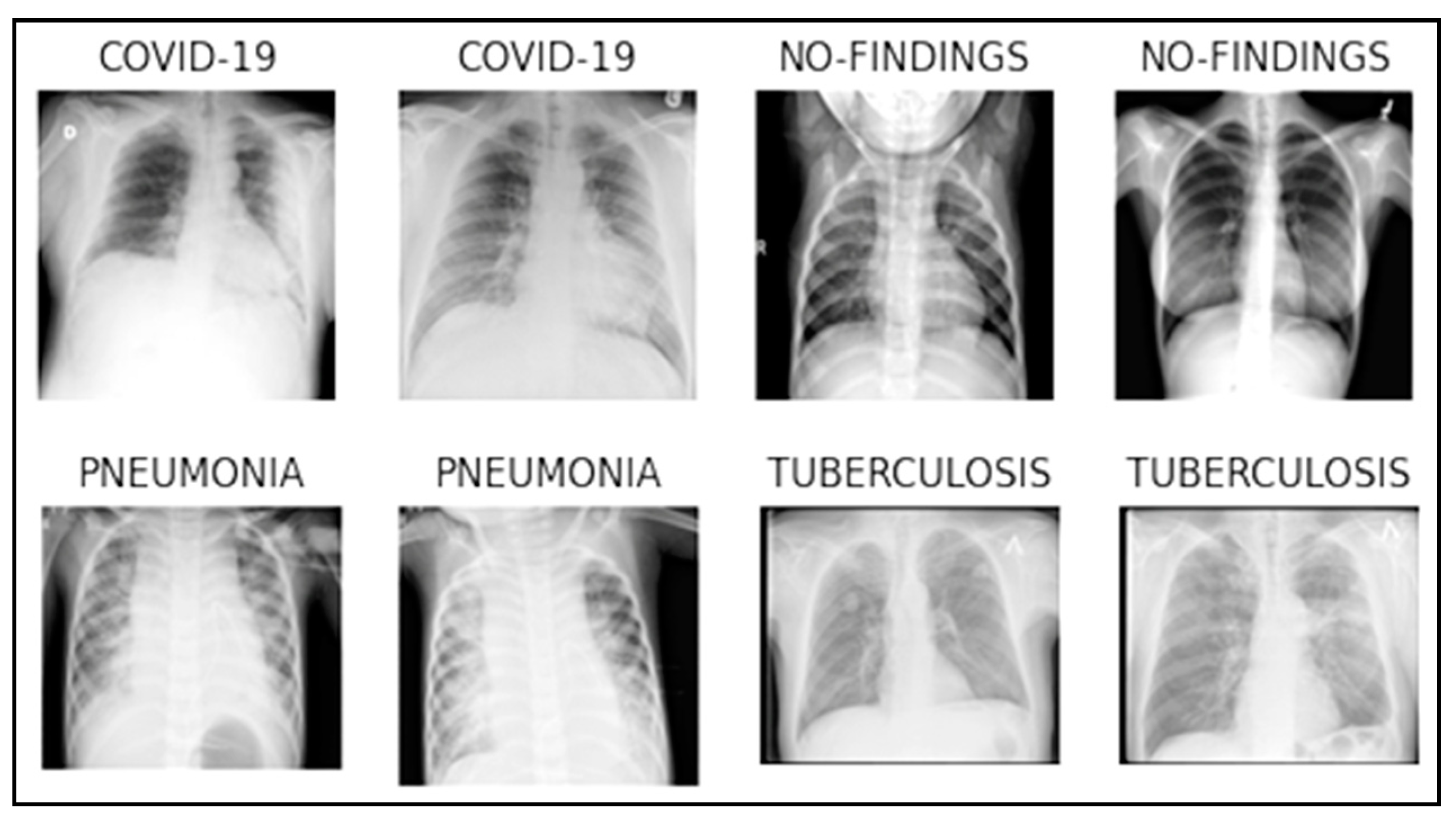 klebsiella pneumoniae x ray