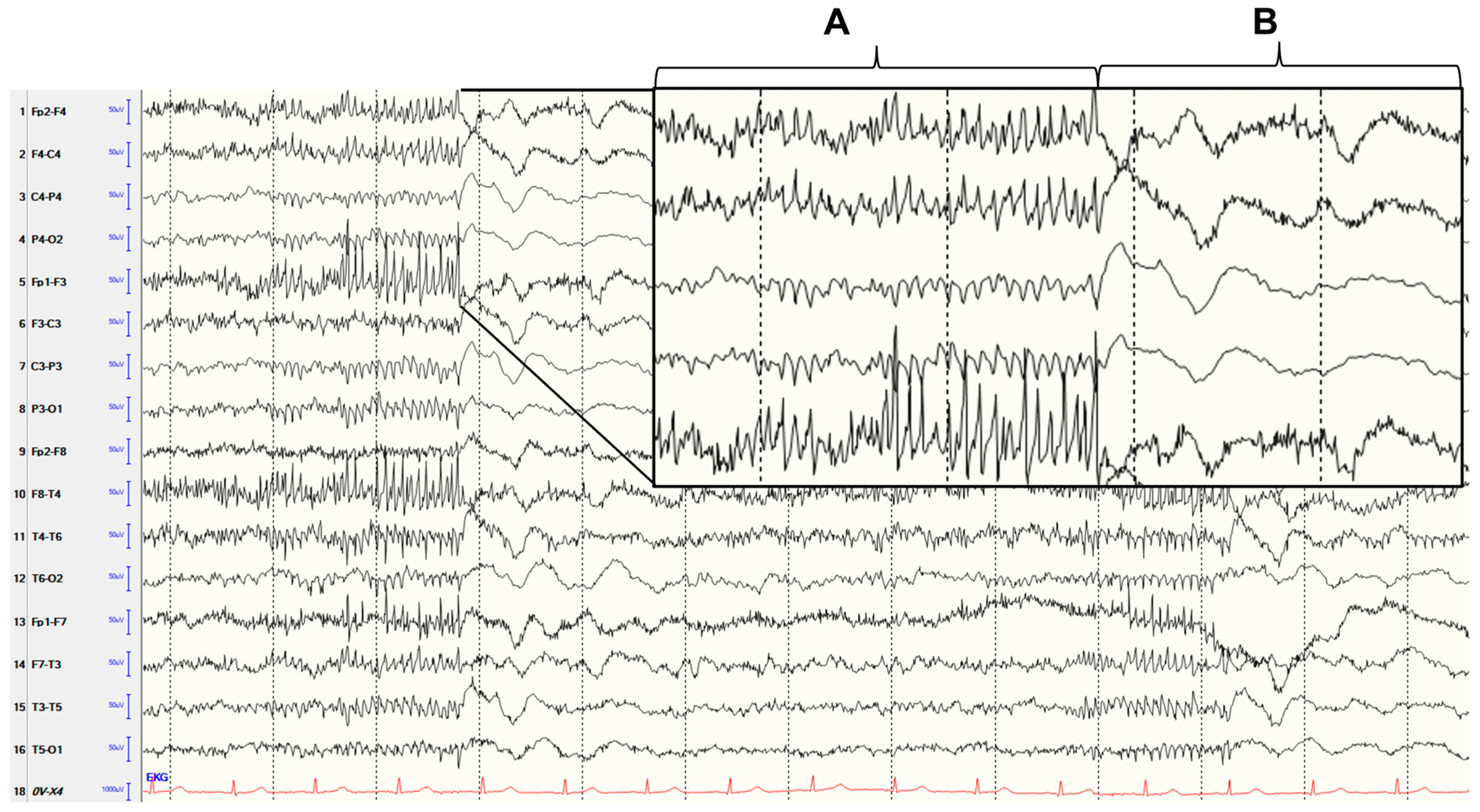 Diagnostics | Free Full-Text | Generalized Polyspike Pattern in EEG Due to  Aseptic Meningoencephalitis
