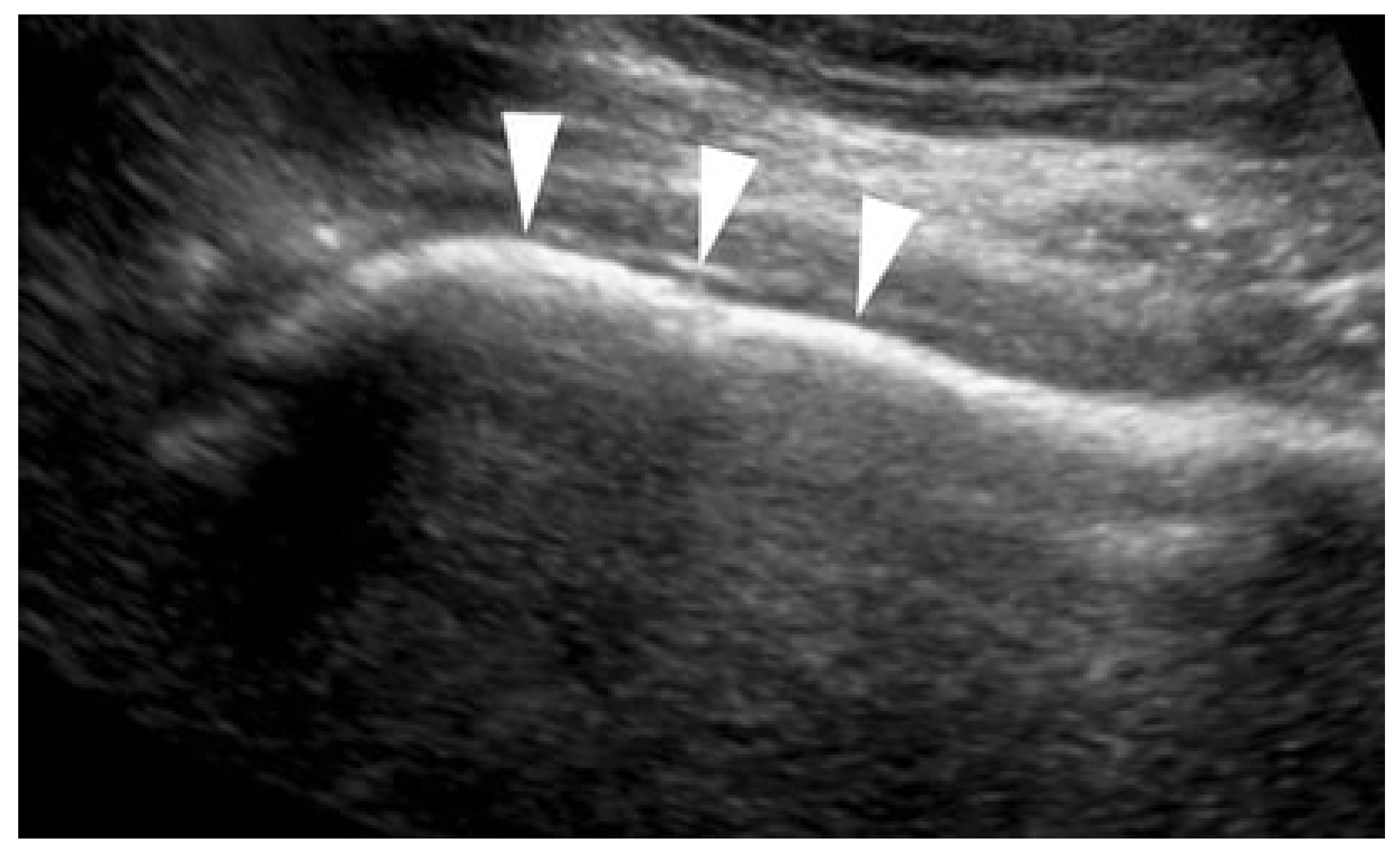 High-resolution ultrasound of the fascia lata iliac crest attachment:  anatomy, pathology, and image-guided treatment