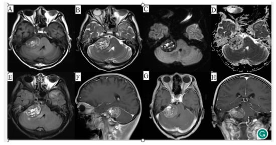 Inflammatory myofibroblastic tumour of an unusual presentation in the uterine  cervix: a case report, World Journal of Surgical Oncology