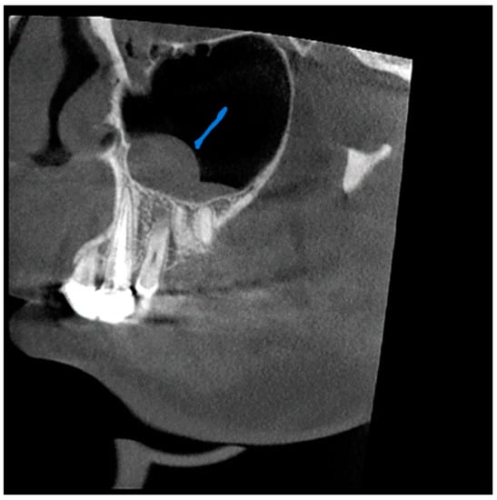 Diagnostics Free Full Text Prevalence Of Incidental Maxillary Sinus Anomalies On Cbct Scans