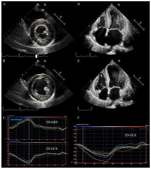 Global Longitudinal Strain and Global Circumferential Strain by  Speckle-Tracking Echocardiography and Feature-Tracking Cardiac Magnetic  Resonance Imaging: Comparison with Left Ventricular Ejection Fraction -  ScienceDirect