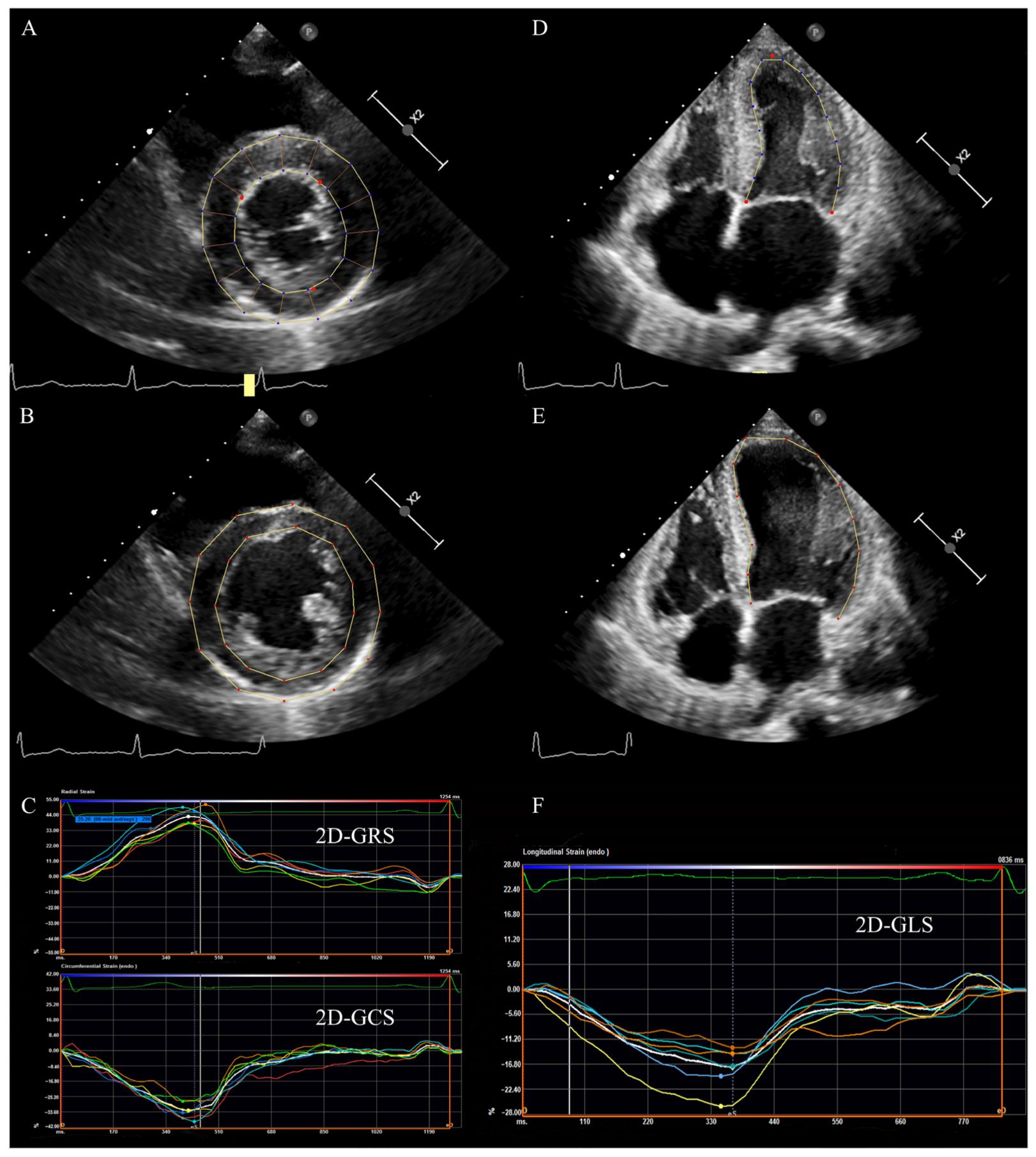 Clinical Applications of Echo Strain Imaging: a Current Appraisal