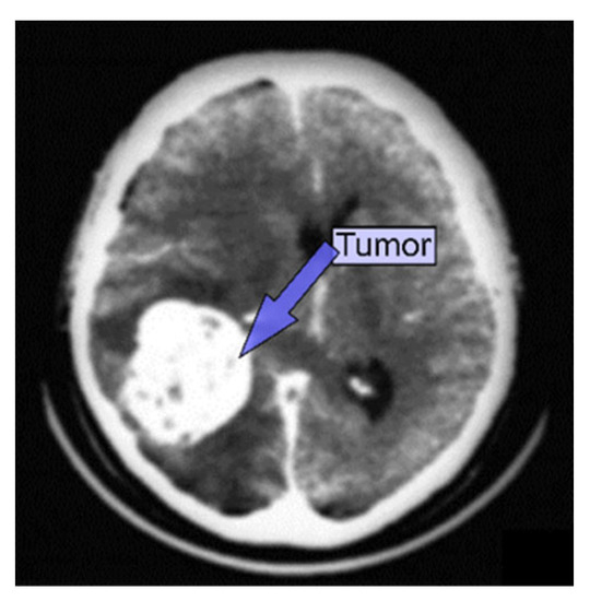 Neuroimaging and deep learning for brain stroke detection - A review of  recent advancements and future prospects - ScienceDirect