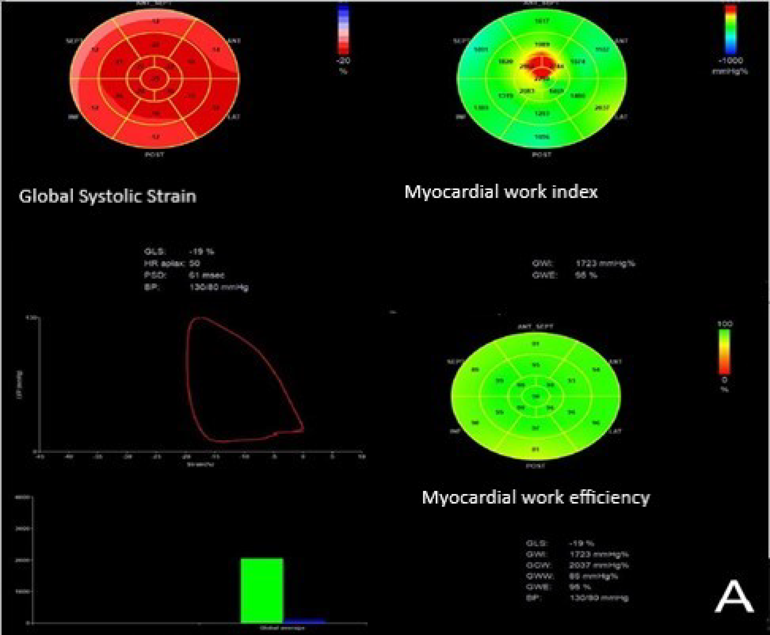 Practical assessment of myocardial work. a Global longitudinal strain