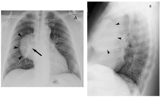 The Neck-Chest brace (a) anterior view, (b) lateral view showing