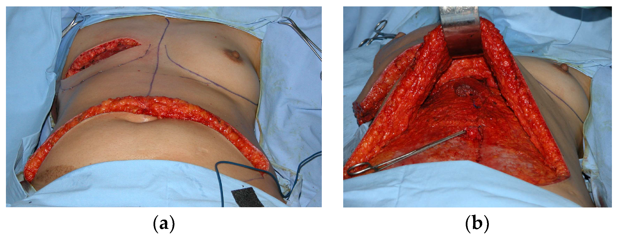 Silicone Breast Prosthesis After Breast Cancer Stock Photo