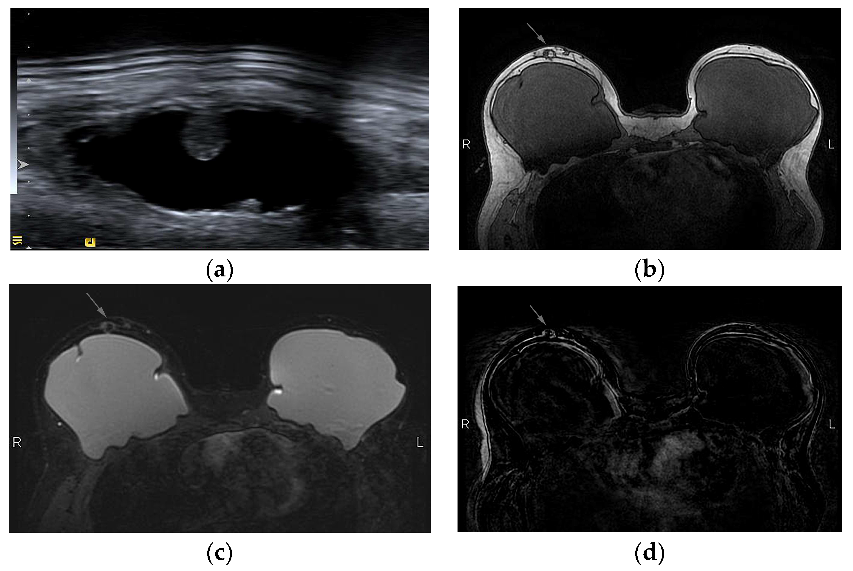 Diagnostics | Free Full-Text | Imaging of the Reconstructed Breast