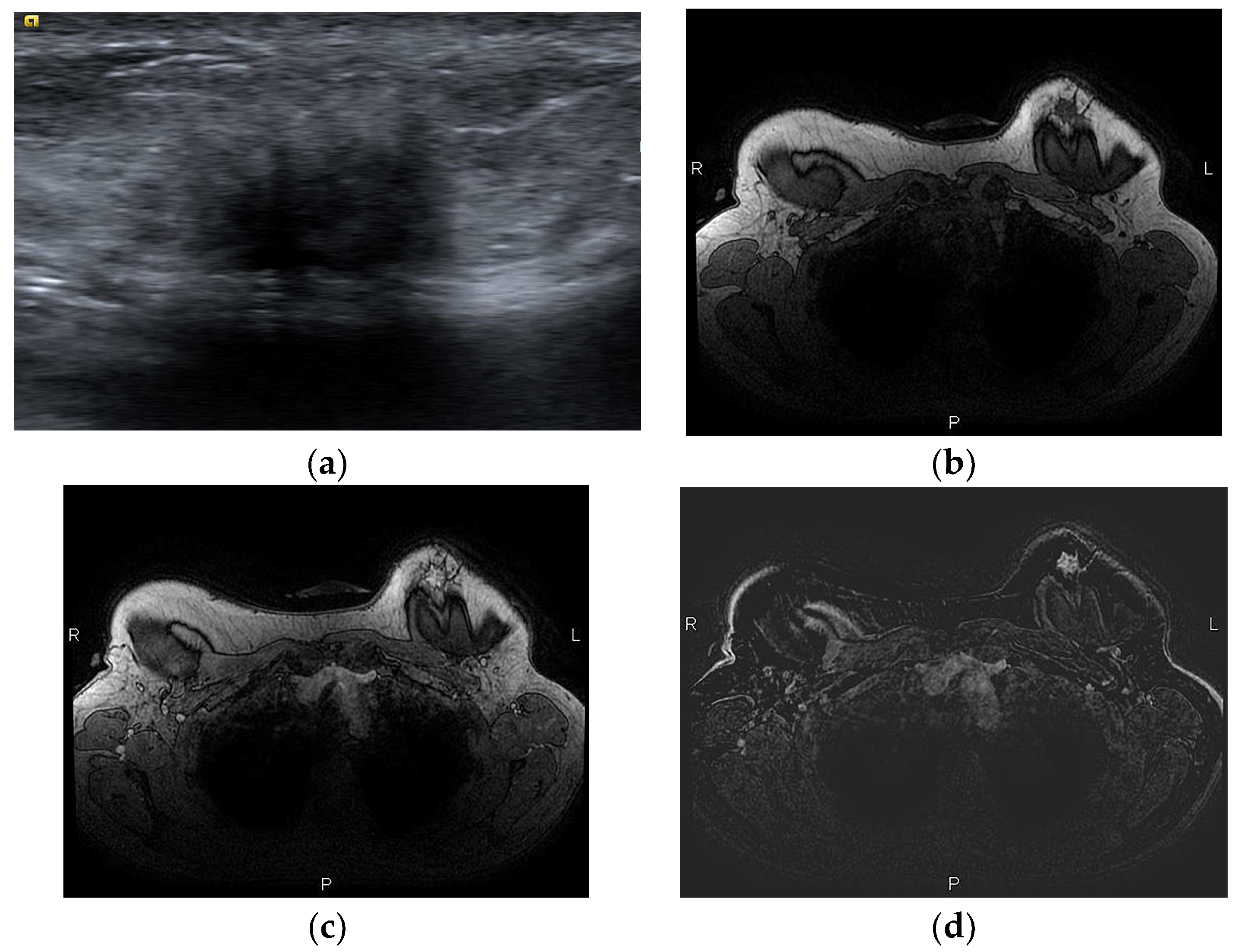 Thigh scar in breast reconstruction surgery - Stock Image - C038/2383 -  Science Photo Library