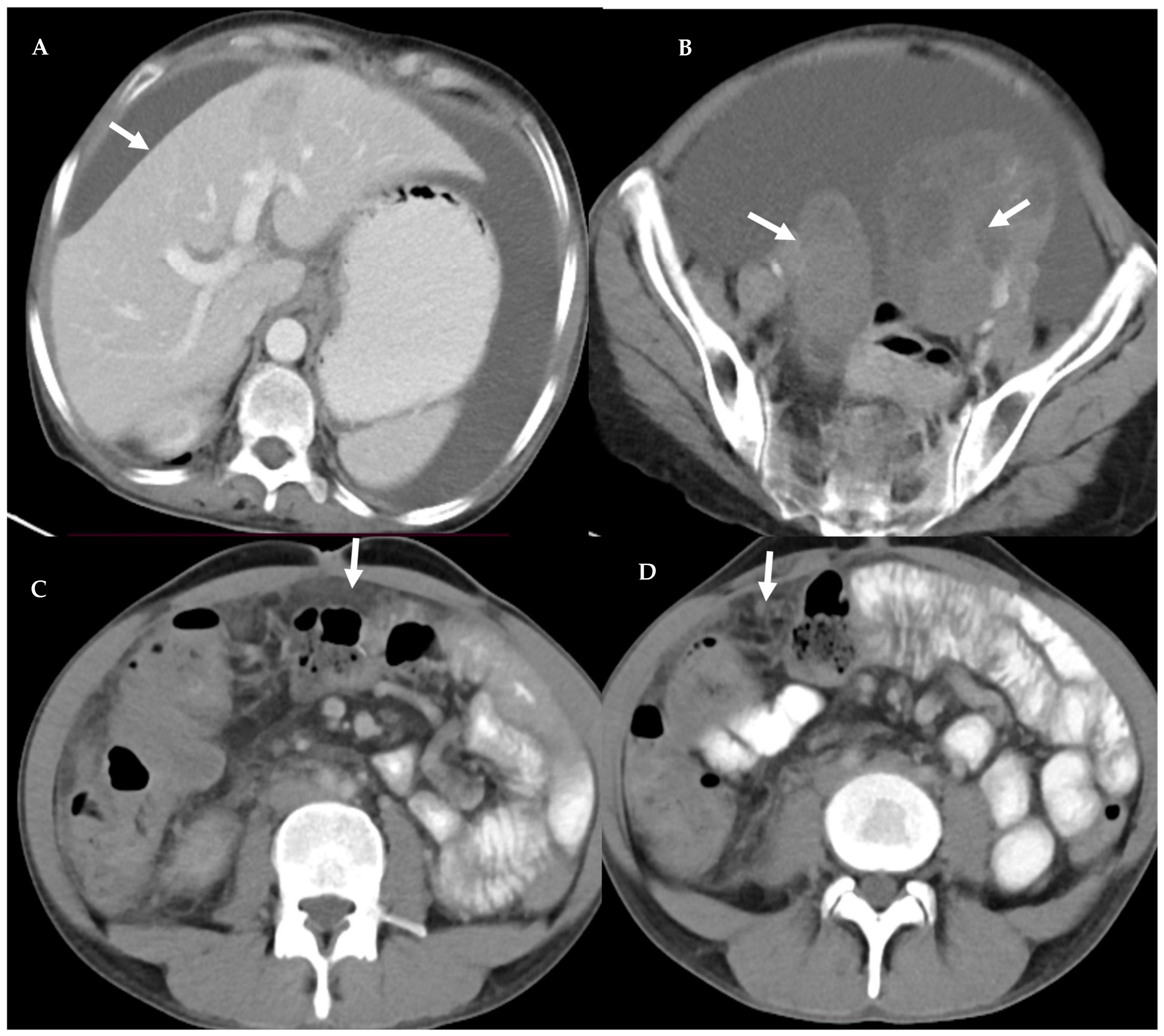 Epiploic Appendagitis: An Entity Frequently Unknown to  Clinicians—Diagnostic Imaging, Pitfalls, and Look-Alikes | AJR