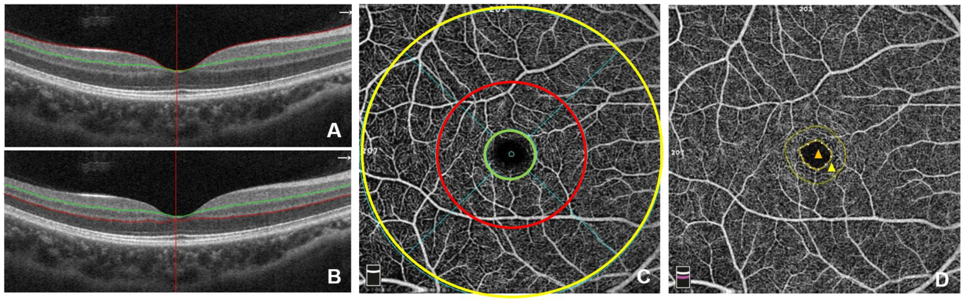 Altered ocular microvasculature in patients with systemic sclerosis and  very early disease of systemic sclerosis using optical coherence tomography  angiography