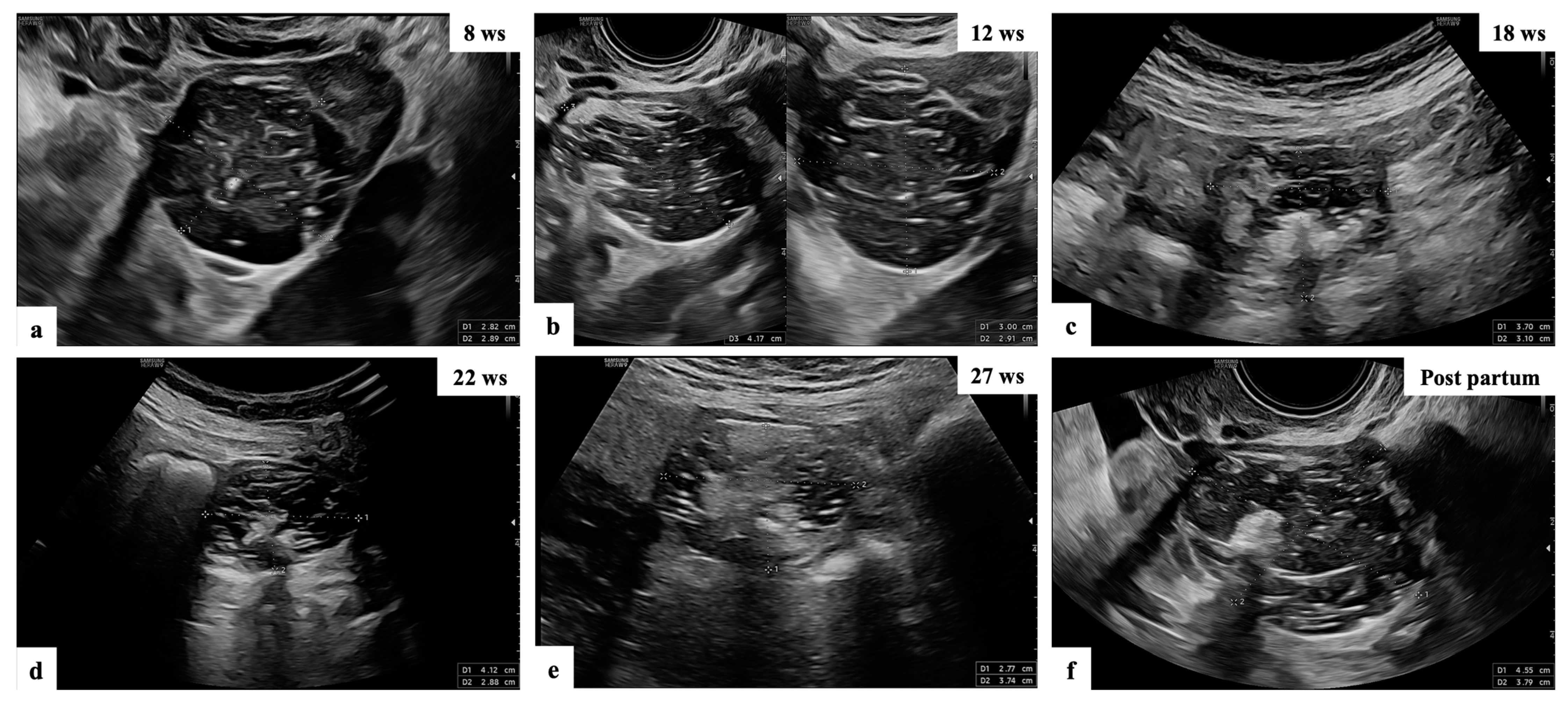 Corpus luteum, Radiology Reference Article
