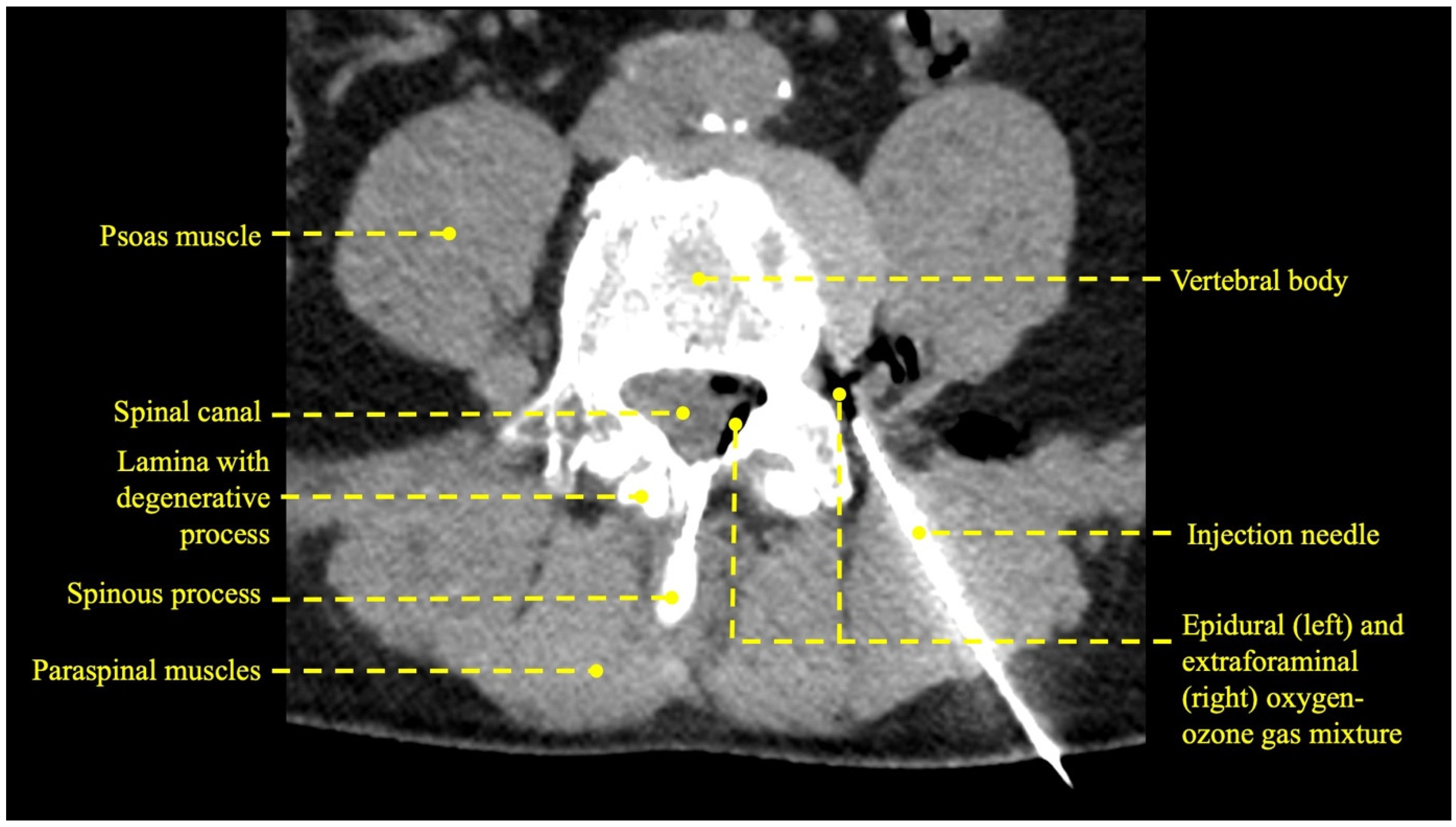 Iliopsoas Syndrome - Orthopaedic Spine Surgery Singapore