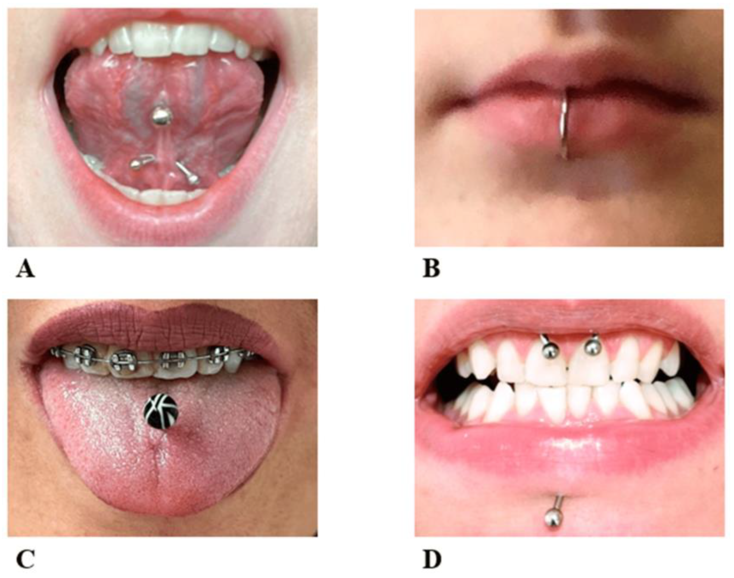 Diagnostics | Free Full-Text | Oral Complications Associated with the  Piercing of Oral and Perioral Tissues and the Corresponding Degree of  Awareness among Public and Professionals: A Systematic Review