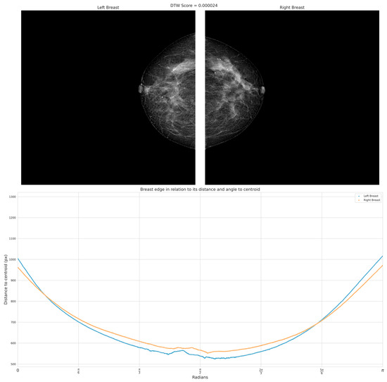 a 40-year-old patient with breast asymmetry and unevenness in the