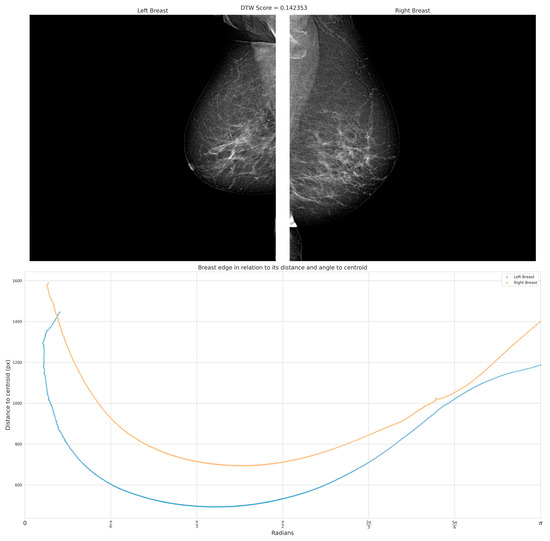 a 40-year-old patient with breast asymmetry and unevenness in the