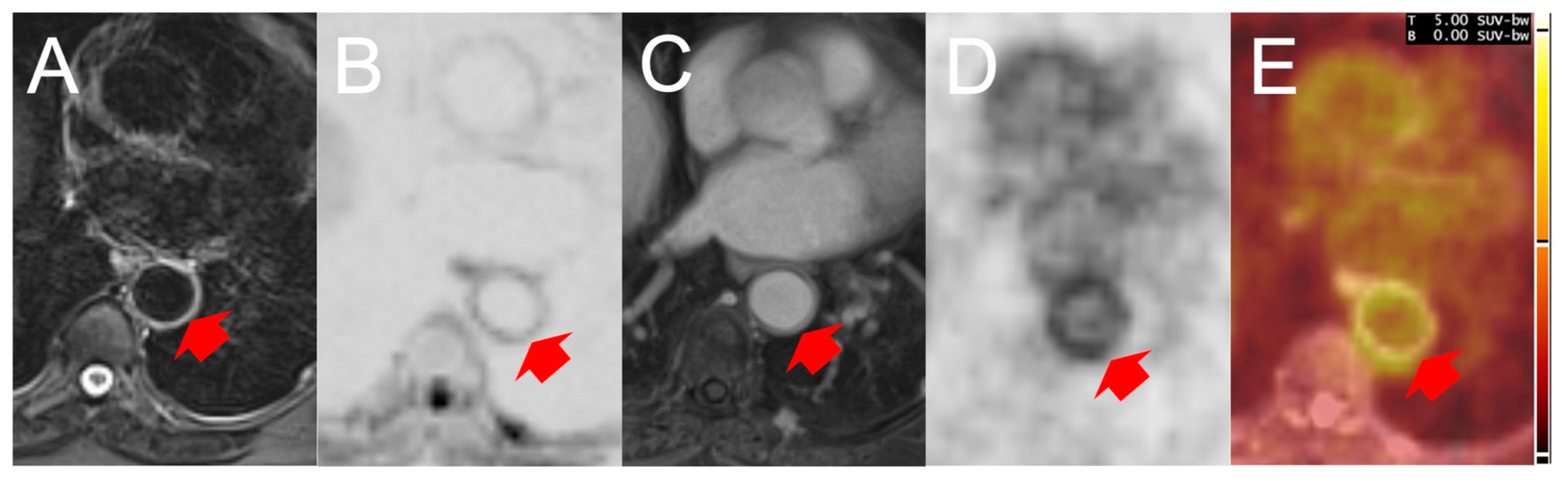 Diagnostics | Free Full-Text | Magnetic Resonance Imaging Findings  Corresponding to Vasculitis as Defined via [18F]FDG Positron Emission  Tomography or Ultrasound