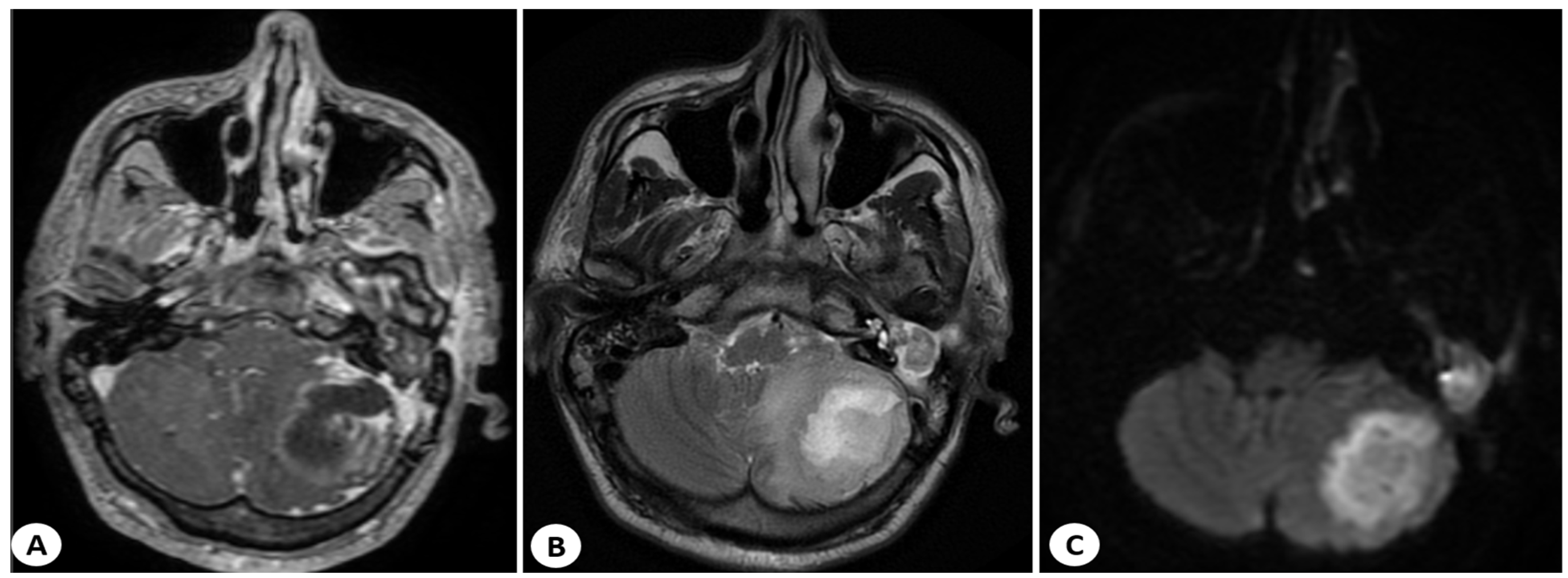 Diagnostics | Free Full-Text | Cerebellar Abscess Secondary to ...