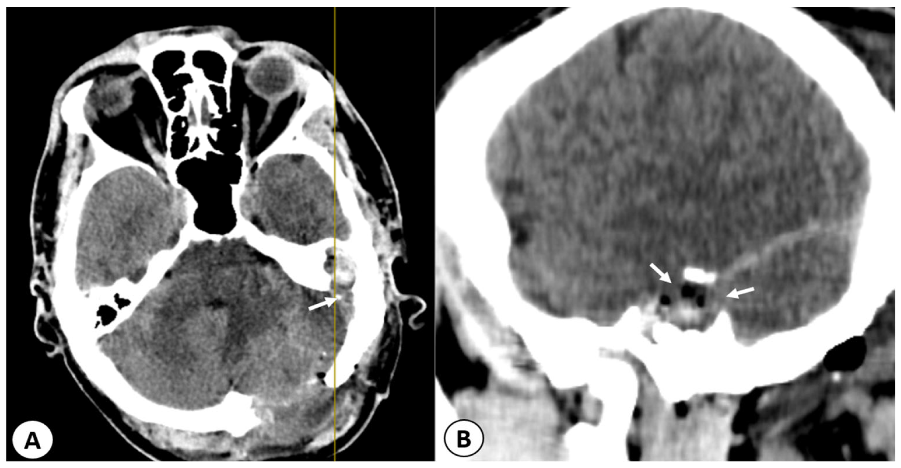 Diagnostics | Free Full-Text | Cerebellar Abscess Secondary to ...