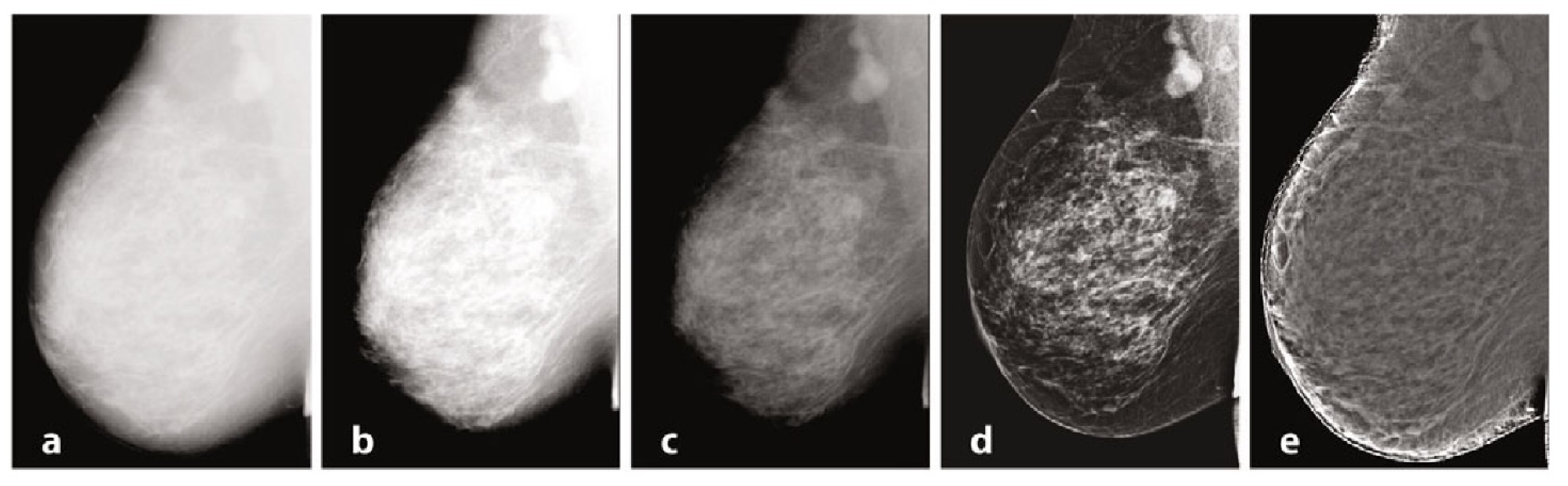 Does Breast Thermo-Imaging Succeed Where Mammograms Fail In The Early  Detection of Breast Cancer?