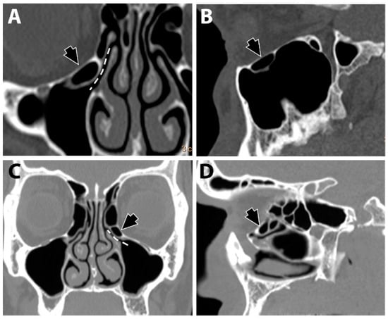 Diagnostics | Free Full-Text | The Associations between the Maxillary ...