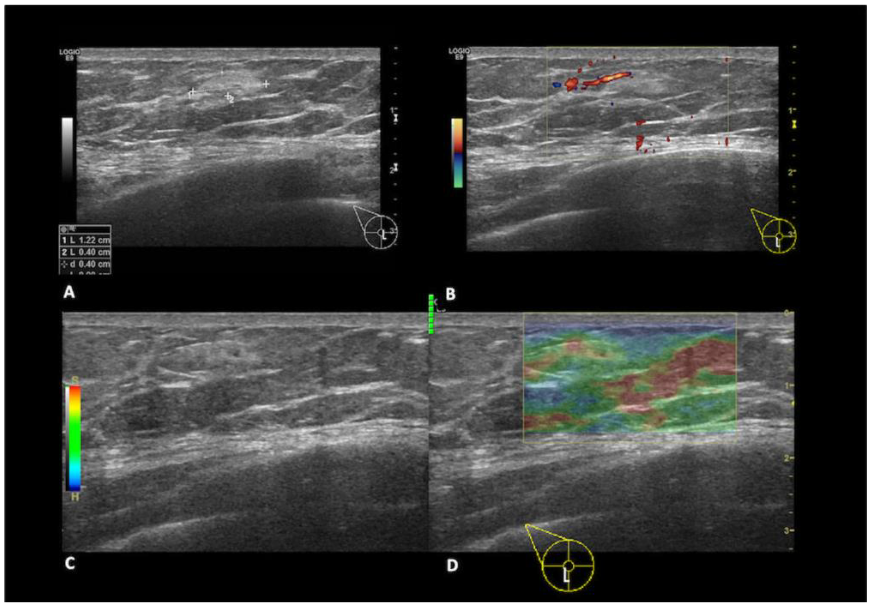 The Radiology Assistant : Pathology of the Male Breast