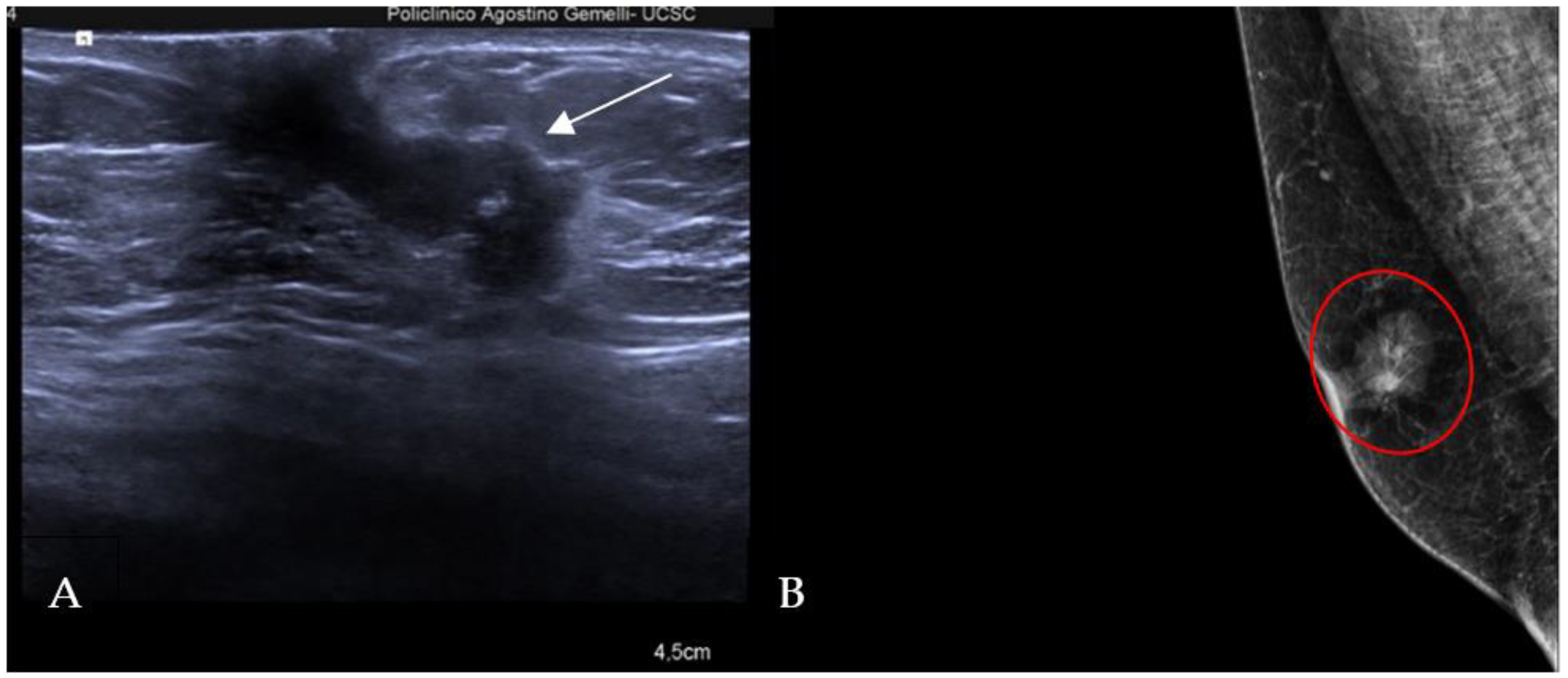 The Radiology Assistant : Pathology of the Male Breast