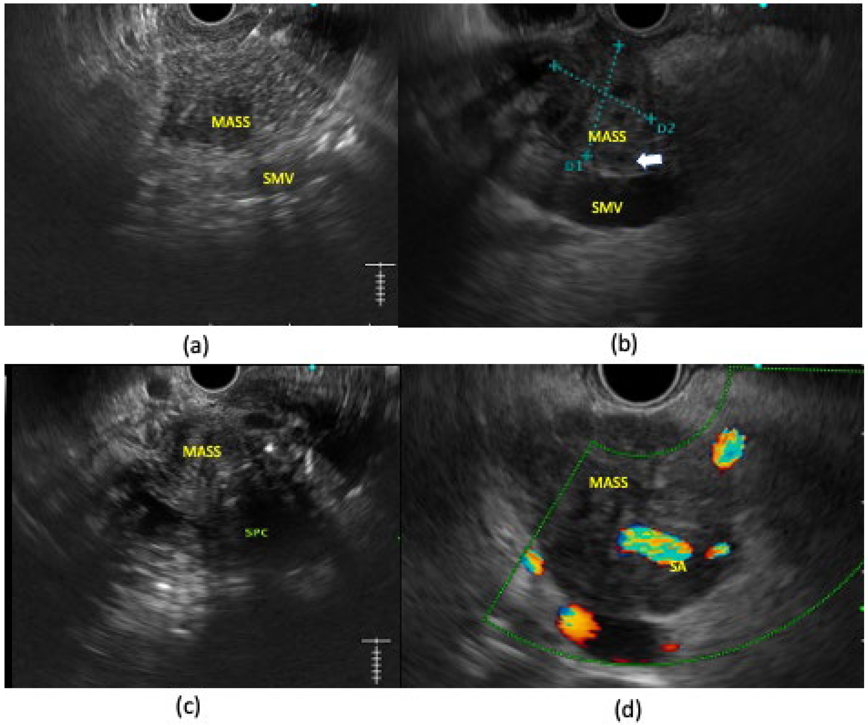 Diagnostics Free Full Text Role Of Endoscopic Ultrasound In Diagnosis Of Pancreatic Ductal 8960