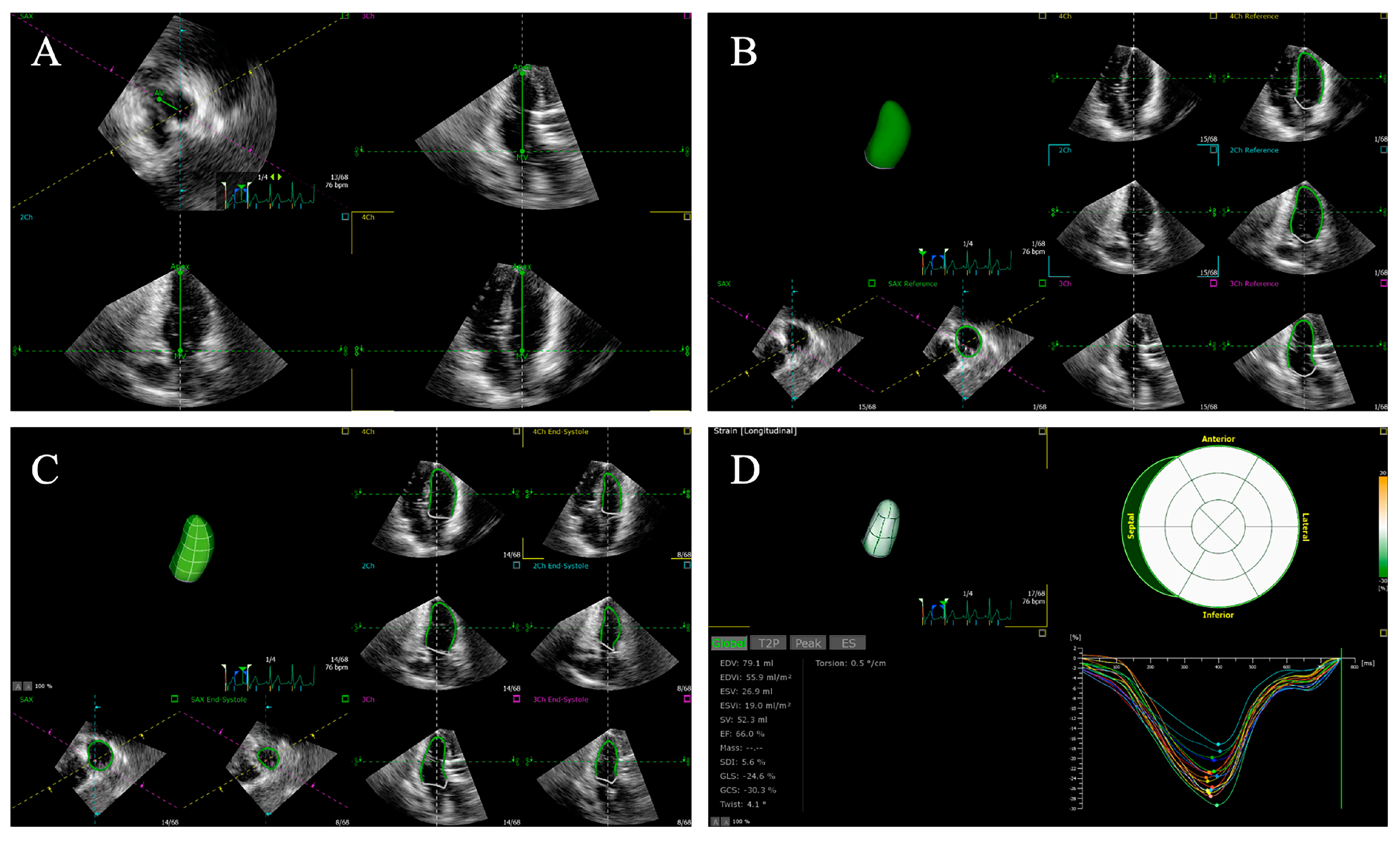 Diagnostics | Free Full-Text | Application Of Speckle Tracking ...