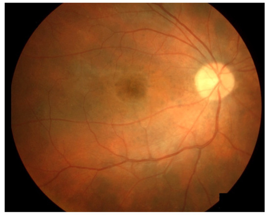 Diagnostics | Free Full-Text | Diagnosing and Managing Uveitis Associated  with Immune Checkpoint Inhibitors: A Review