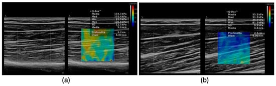 Diagnostics Free Full Text Ultrasound Evaluation of Sarcopenia