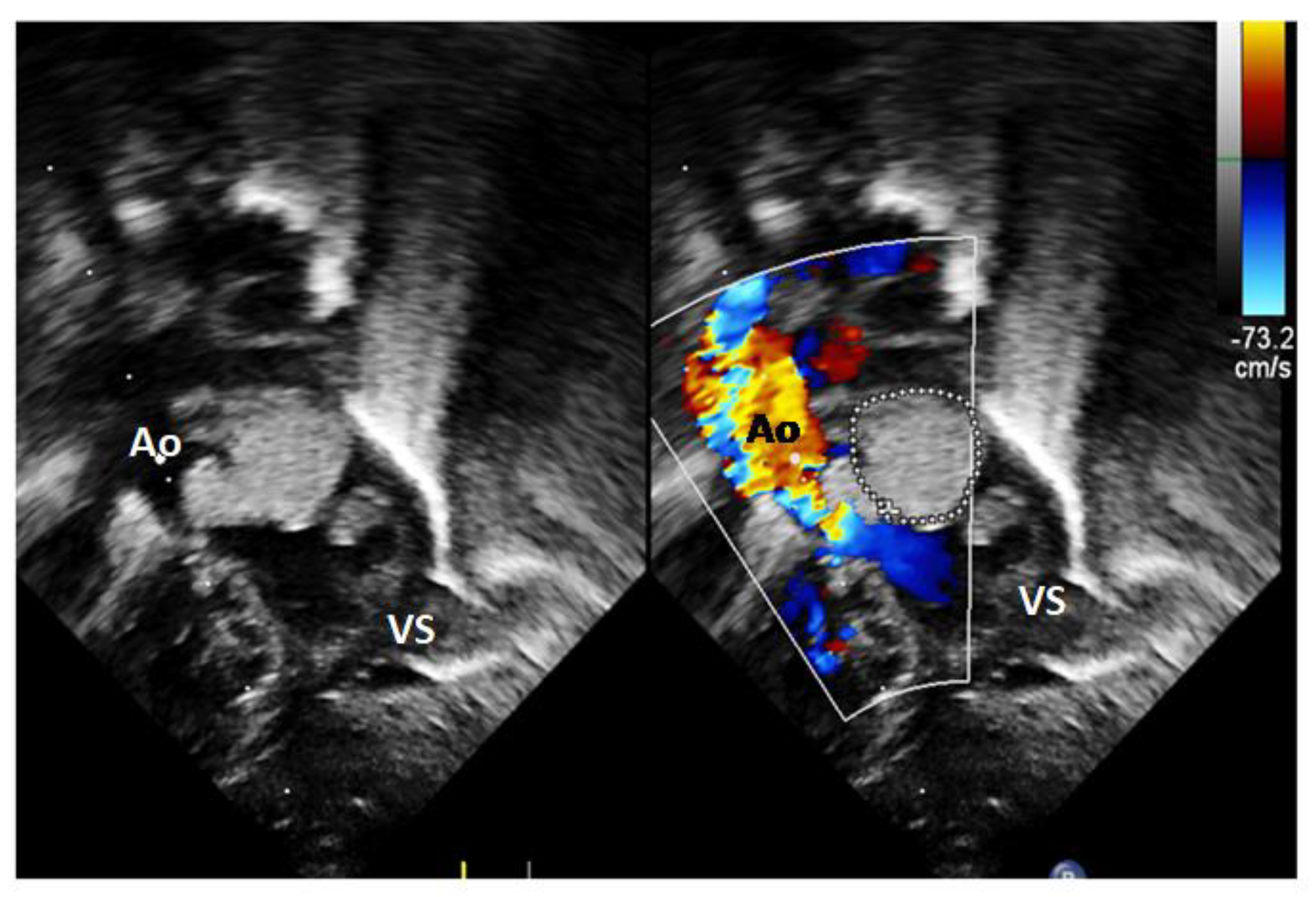 Diagnostics | Free Full-Text | Regression of Cardiac Rhabdomyomas ...