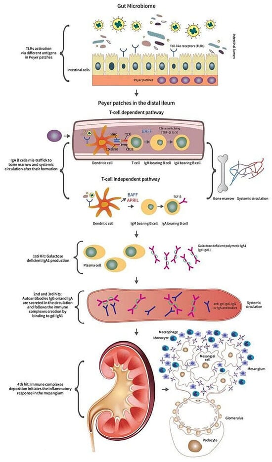 Diagnostics | Free Full-Text | Diagnosing and Treating IgAN: Steroids ...