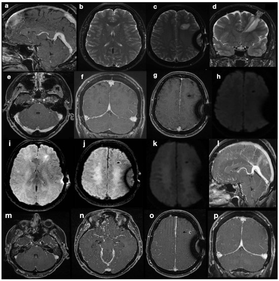 Diagnostics | Free Full-Text | Rare Complications of CSF Diversion ...