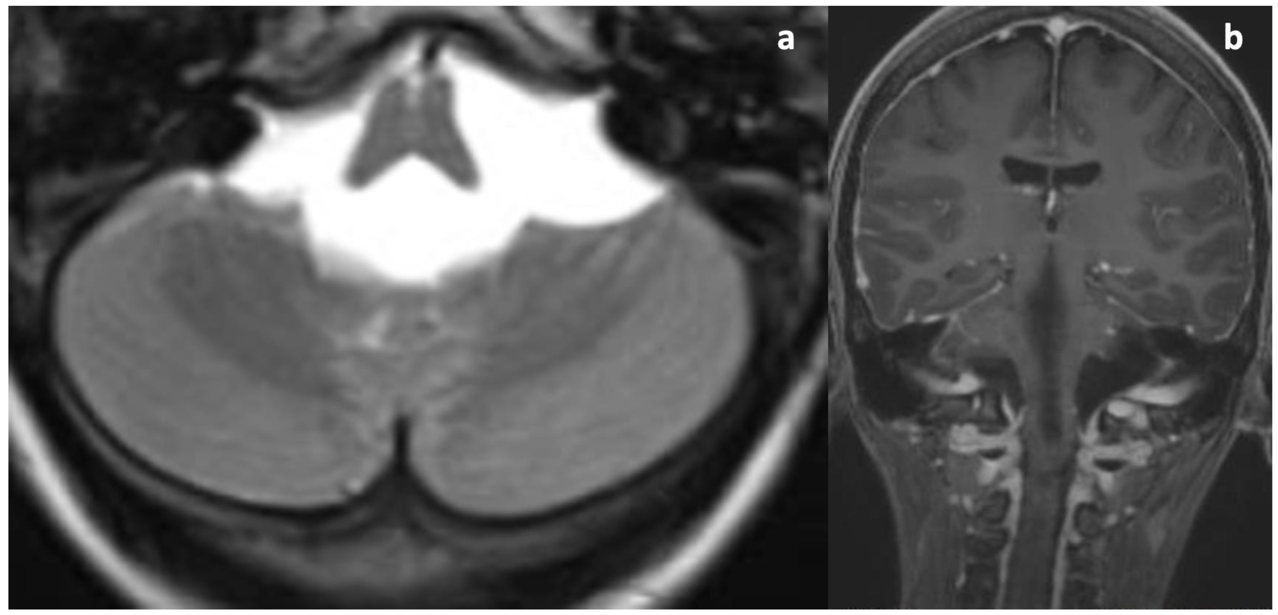 Diagnostics | Free Full-Text | Rare Complications of CSF Diversion ...