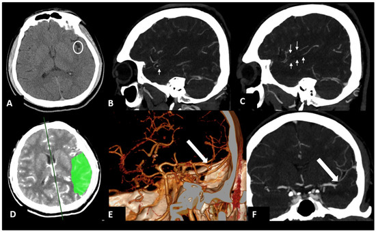 Using High-Resolution Vessel Wall Magnetic Resonance Images in a ...